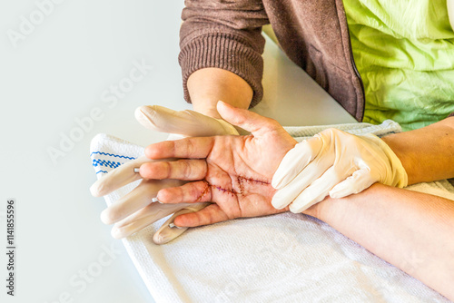 hand physiotherapy to recover a broken finder photo