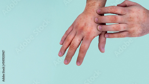Men's hands showing rash due to Pox viral infection Painful red blistering skin Health problem in the palm of the hand Copy space. Allergic reaction Skin inflammation Dengue fever and Mpox disease.