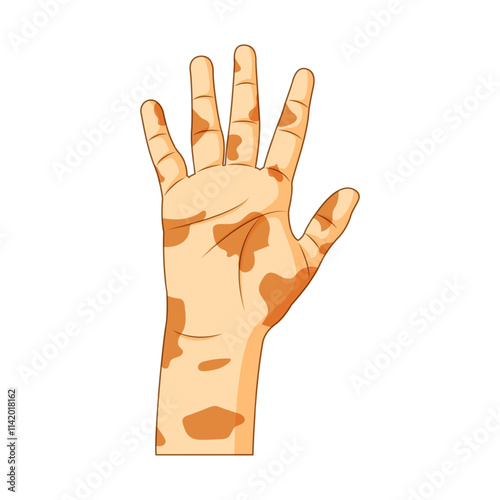 Vector illustration of Leprosy patient hand on transparent background