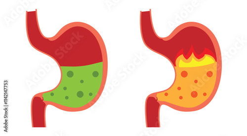 Normal and High Acidity of a Stomach. Healthcare and medicine, human digestive processes vector art