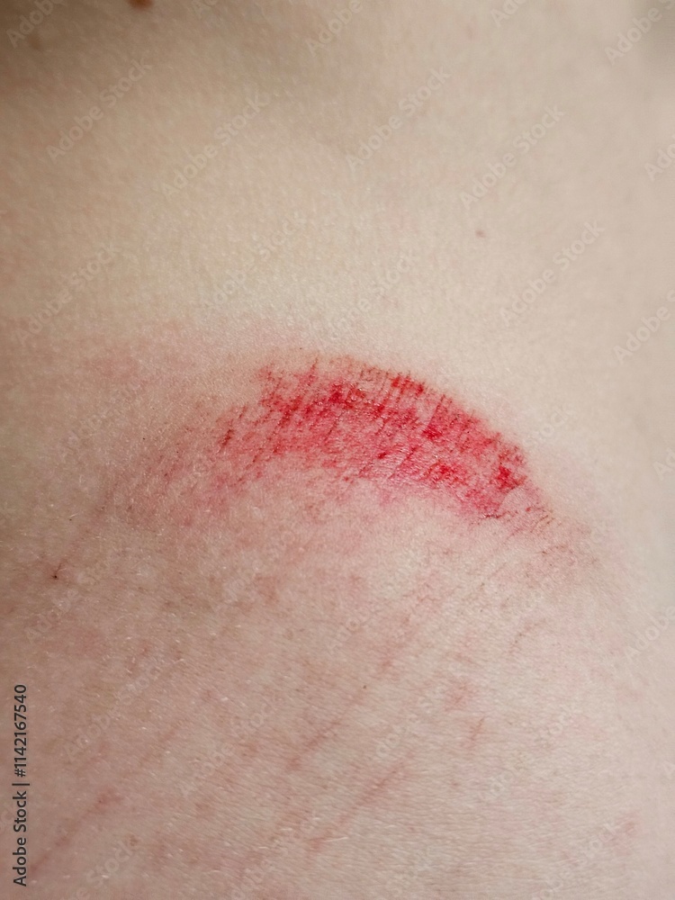 Unhealed wound with visible redness and irritation Unhealed wound with visible redness and irritation