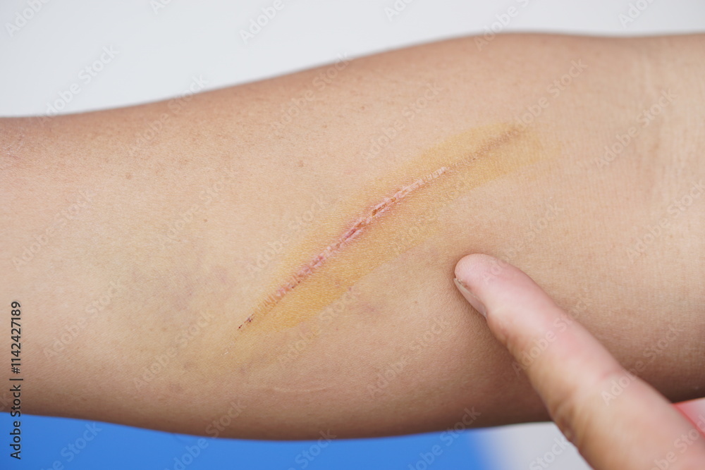 Fototapeta premium Scratch wound on arm skin. Concept, physical injury from accident. It can be scar on skin after it's dry.