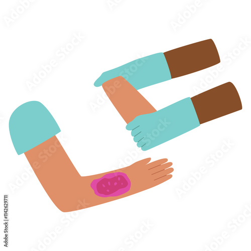 Vector illustration of doctor's hands applying artificial skin to patient, applying artificial skin to damaged skin of hand, treating skin diseases with artificial skin