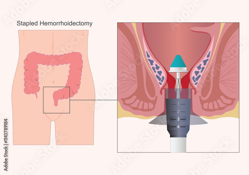 Stapled hemorrhoidopexy is procedure.