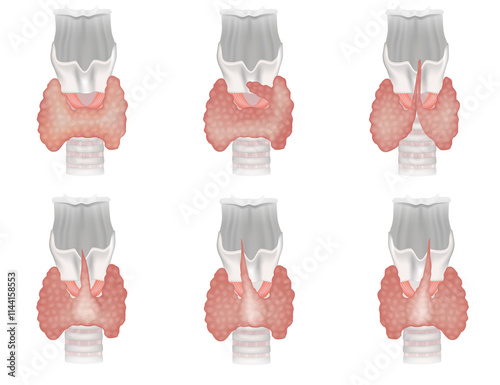 Foto Pyramidal Lobe Variations in Thyroid Anatomy and Pyramidal Lobe