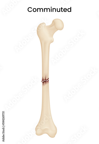 Causes of the Comminuted Fracture