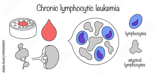 Chronic lymphocytic leukemia