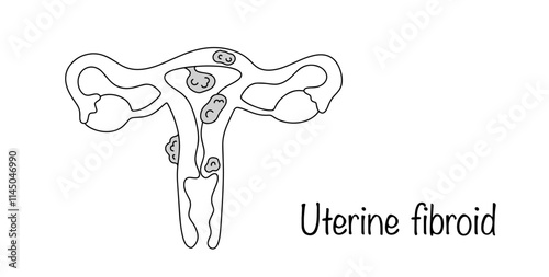 Uterine fibroid