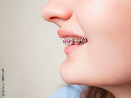 A girl with braces on her teeth is smiling. The braces are pink and have a pink and white design with some decorative glamour elements. Health care concept. Very expensive procedure