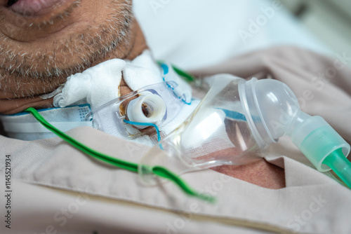 Patients who have undergone a tracheostomy for intubation photo