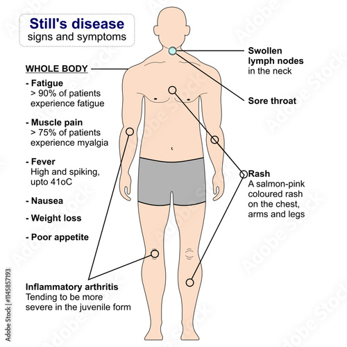 Adult onset Still's disease sign and symptoms