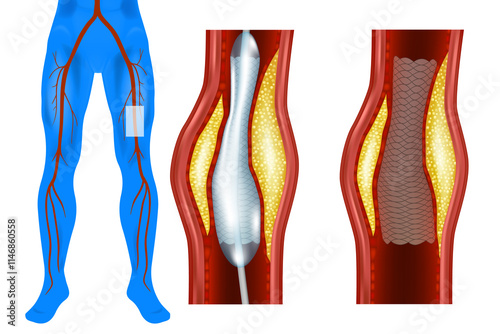 Lower Limb Angioplasty Procedure. Peripheral Artery Angioplasty Diagram. Balloon Angioplasty for Leg Arteries. Stent Placement in Peripheral Artery
