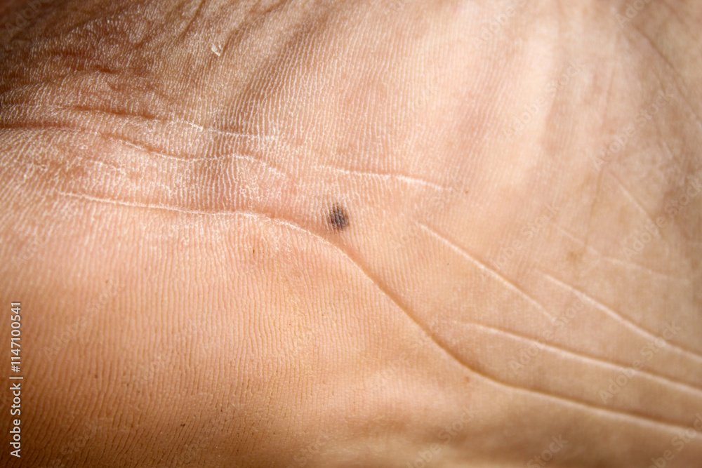 Fototapeta premium close up of mole on sole of foot of man