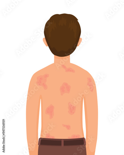 young man having itchy back skin with rash, allergy, dermatitis, skin inflammation, redness and irritation