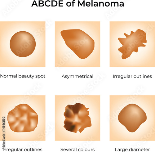 ABCDE of Melanoma Design Vector Illustration