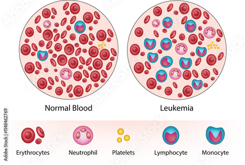 Normal Blood and Leukemia, Erythrocytes, Neutrophils, Platelets, Lymphocytes, Monocytes, Vector Illustration