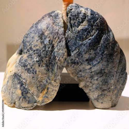 Evidence of damage on smoker lungs 
