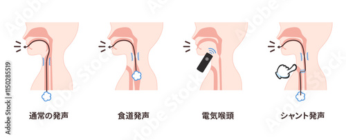 喉頭癌の手術後の発声方法のイラスト_通常の発声_食道発声_電気喉頭_シャント発声