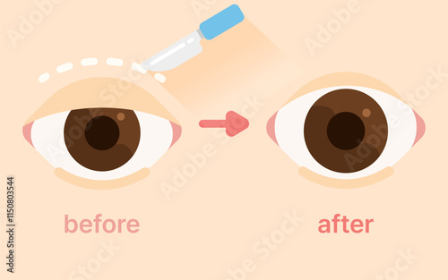double eyelid surgery blepharoplasty plastic surgery
