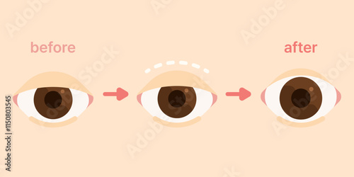 double eyelid surgery blepharoplasty plastic surgery