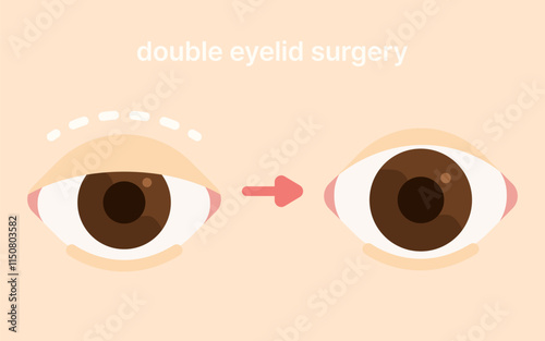 double eyelid surgery blepharoplasty plastic surgery
