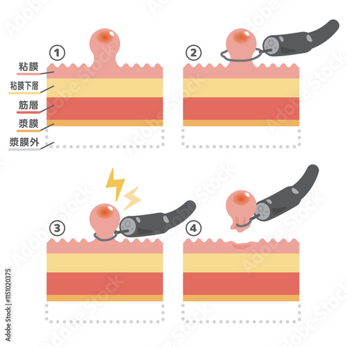 内視鏡治療　ポリペクトミーのイラスト