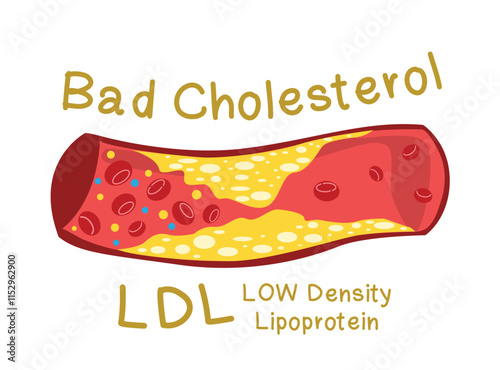 LDL (Bad cholesterol) in blood vessels - Type of Cholesterol