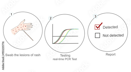 The diagnosis workflow: nucleic acid  detection in the rash lesion with PCR technique on swab sample for diagnosis of viral infection or other: sample collection,real-time PCR test and result report.