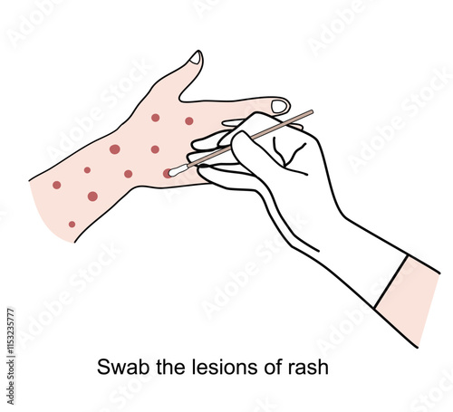 The picture shows the medical staff was swabbing the lesions of rash for laboratory testing and disease diagnosis.