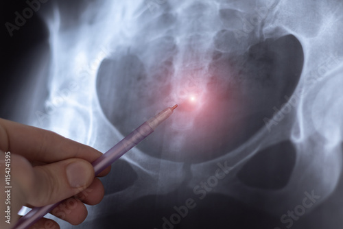 Doctor learn X-ray image of big hernia in pelvic spine. Orthopedic treatment. Diagnostic, human health care.
