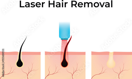 Laser Hair Removal Design Vector Illustration