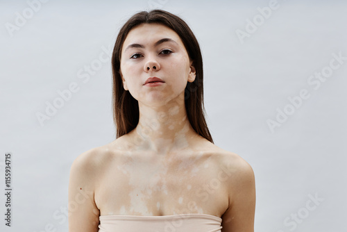 Chest up portrait of pretty brunette woman with vitiligo posing confidently with bare shoulders against white background embracing beauty of unique white patches on body in studio, copy space photo