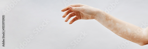 Website header shot of female arm with vitiligo patches in elegant gesture against white backdrop in studio, copy space