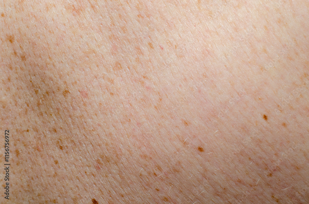 Fototapeta premium Nevus on human skin close-up
