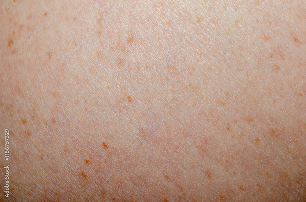 Fototapeta premium Nevus on human skin close-up
