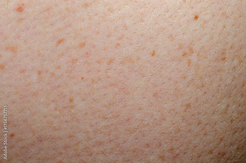 Fototapeta premium Nevus on human skin close-up