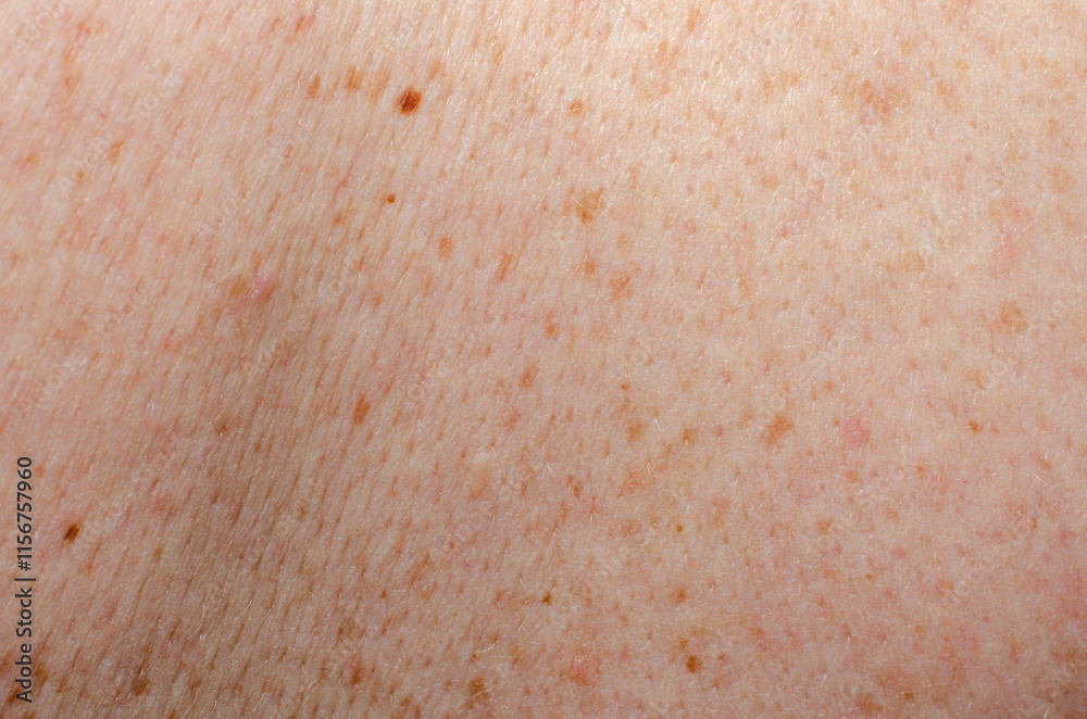 Fototapeta premium Nevus on human skin close-up