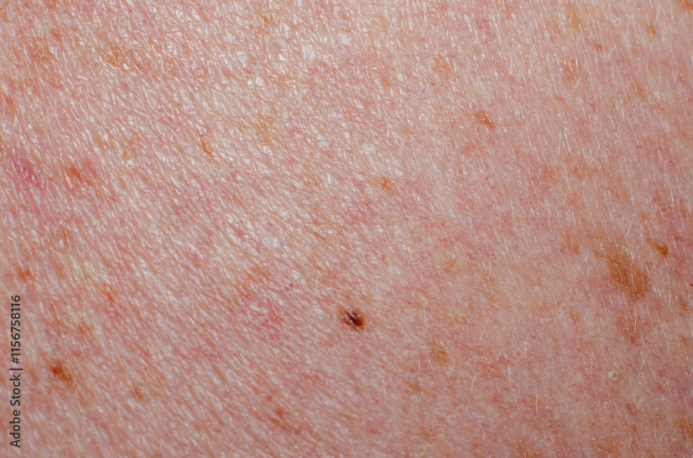 Fototapeta premium Nevus on human skin close-up