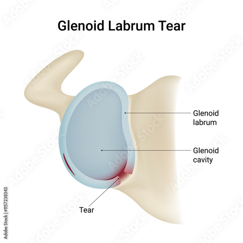 Causes of Glenoid Labrum Tear
