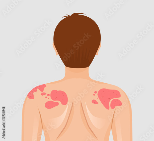 illustration of skin disease concept. Skin rash, psoriasis, dermatitis or eczema