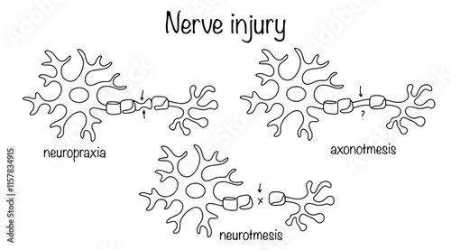 Nerve injury