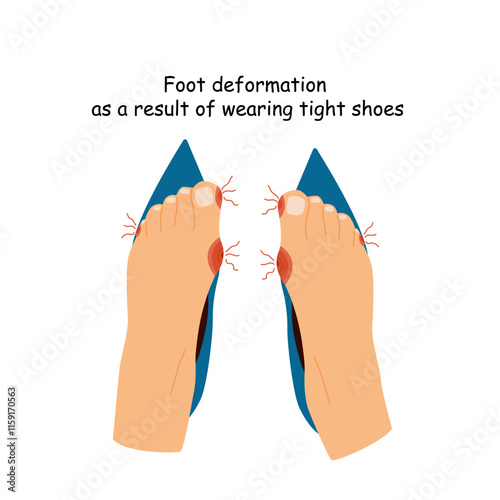 Barefoot shoes. Feet with bunions.  Narrow heeled shoes. Tight shoes and heels lead to foot problems, bone deformities, redness and inflammation