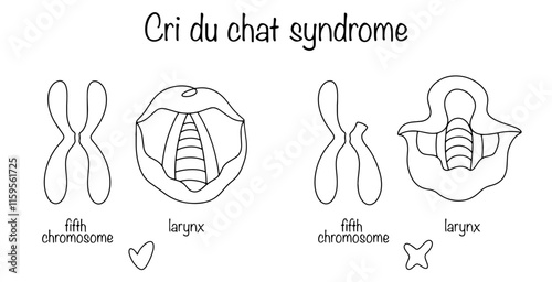 Cri du chat syndrome