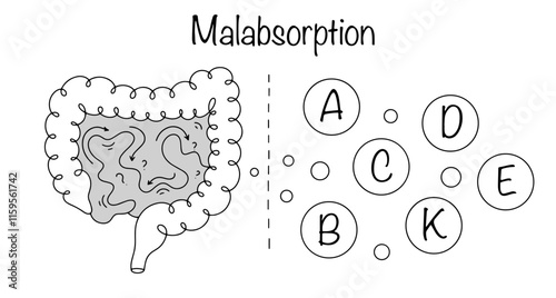 Malabsorption