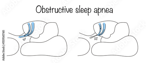 Obstructive sleep apnea
