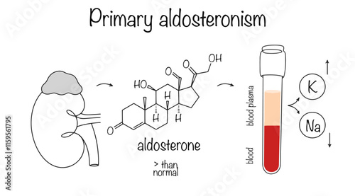 Primary aldosteronism