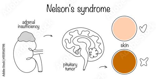 Nelson's syndrome