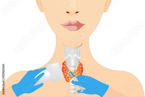 Thyroid cancer disease, nodules, ultrasound screening, medical treatment, fine needle aspiration, lumps, test lab, gland, neck pain