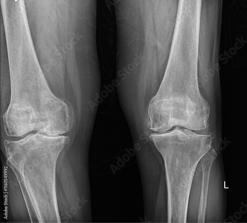 Knee Joint Imaging for Cartilage Wear Assessment