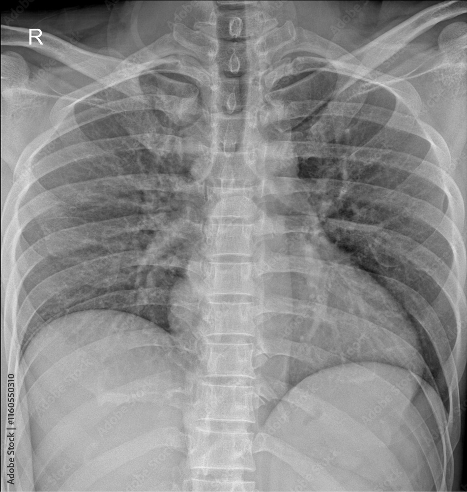 Trauma Imaging: Chest X-ray for Rib Fractures Trauma Imaging: Chest X-ray for Rib Fractures